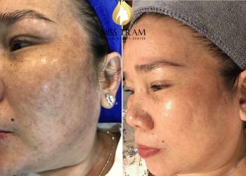 Cách Trị Nám Hiệu Quả Nhất: Giải Pháp Đột Phá Cho Làn Da Rạng Rỡ