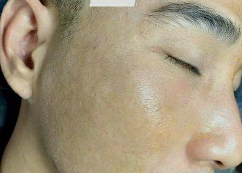 Điều Trị Sẹo Rỗ Tại Miss Tram Spa – Địa Chỉ Uy Tín Và Hiệu Quả